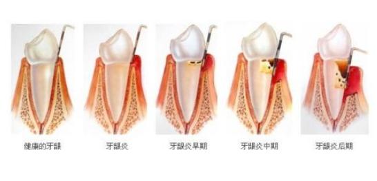 经常用电动牙刷的危害（经常用超声波电动牙刷正确使用方法）