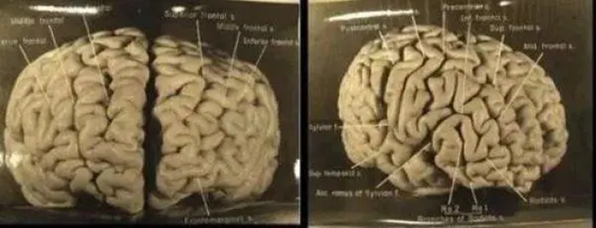 爱因斯坦的大脑被切成240块（爱因斯坦的脑袋为什么被切）