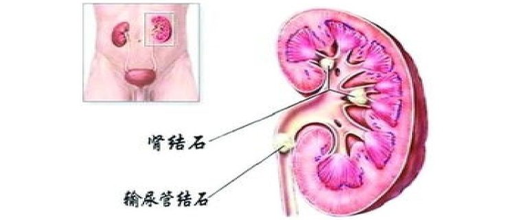 吃蛋白质粉会得结石吗 尿钙排出量增加肾结石风险