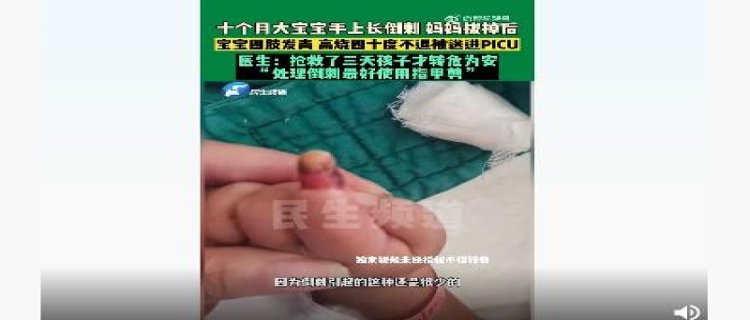 10个月宝宝食指倒刺被拔送PICU抢救 给人们了哪些启示(10个月宝宝食指指甲翻了)