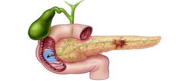 查出胰腺癌能活过5年的人不足10%吗