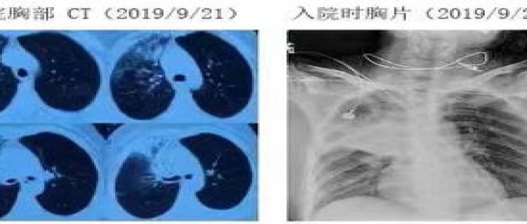 支原体肺炎会一直不好吗